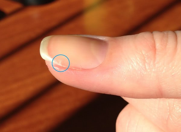 Истончаются ногти – почему и что делать в таких ситуациях?