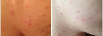 Мой арсенал для ухода за проблемной кожей. Средства для умывания. Часть 2