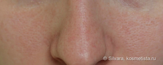 Уход за кожей лица с куперозом отзывы thumbnail