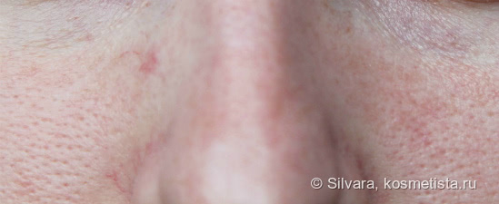 Уход за кожей лица с куперозом отзывы