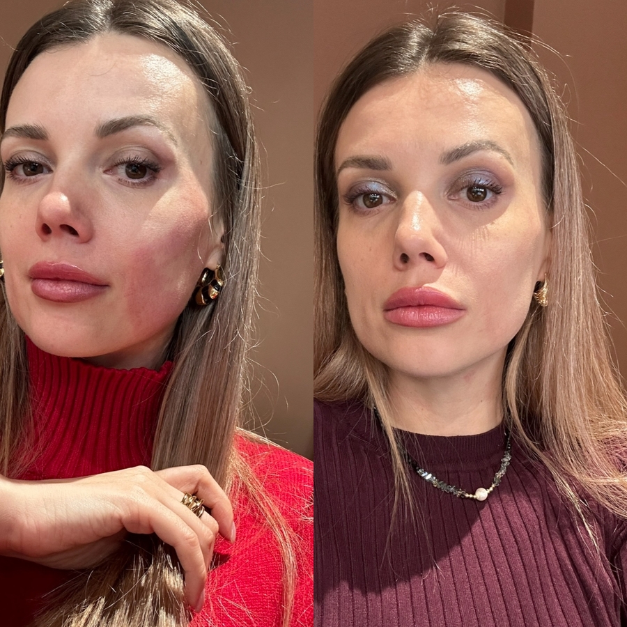 В офисе сразу после процедуры и на след день после. Свет, конечно, ужасающий, но суть понятна.