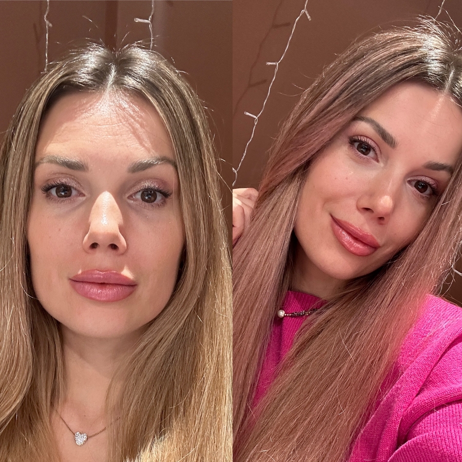 Через неделю слева, есть некоторая отечность, справа через 1.5 недели