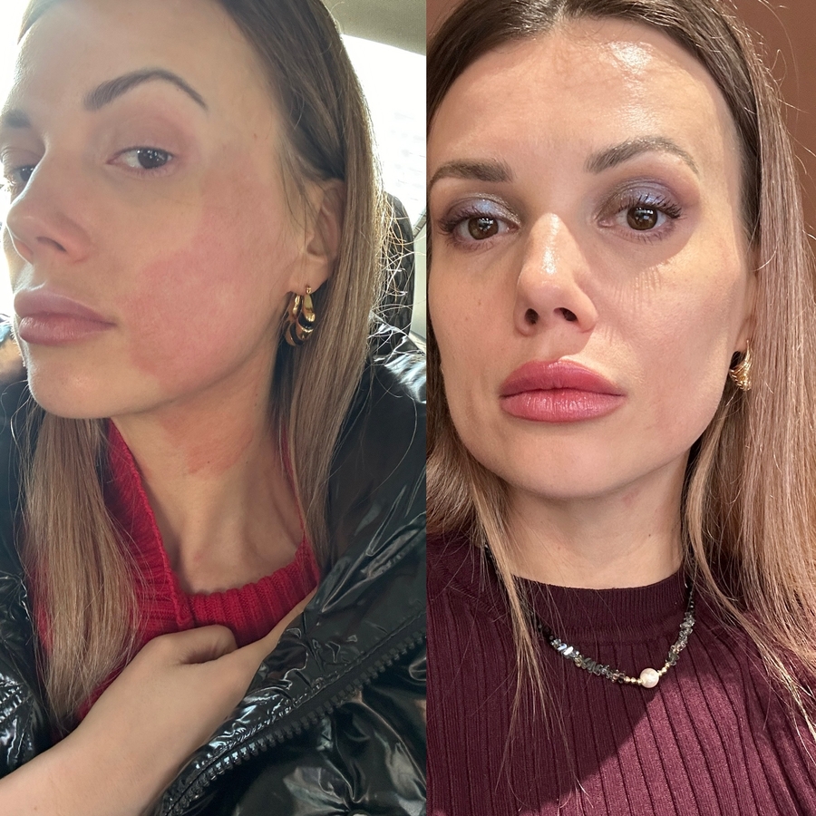 Сразу после первой процедуры /на след день