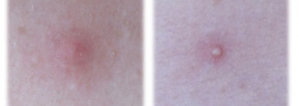 Anna Lotan A-Clear - Herbal Drying Lotion