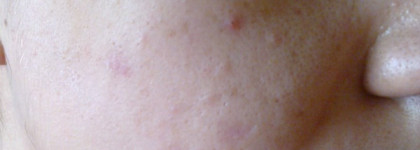 Ежедневный уход. Проблемная кожа