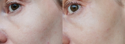 Гельтек гель Retiderm 1.0 - ретинол для кожи 50+