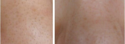 Молодильные яблочки или 7 бед один ответ: Салфетки для профессионального пилинга Alpha-Beta & Retinol Peeling Pads от Holy Land