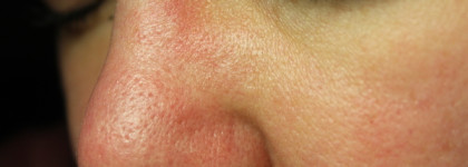 Вычистить поры - Ciracle Pore Control Blackhead Off Sheet. До и после