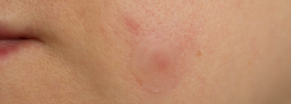 Патчи от прыщей, спасение или очередное баловство, которое не работает?