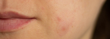 Патчи от прыщей, спасение или очередное баловство, которое не работает?