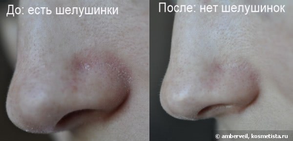 Почему шелушится кожа на носу, и как избавиться от неприятных ощущений
