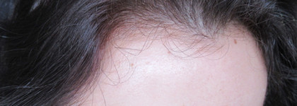 Остановить выпадение волос за пять дней. Ducray Laboratoires Dermatologiques Neoptide Anti-Hair Loss Lotion