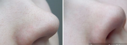 Попытка решить проблему на носу с полосками Essence Pure Skin Purifying Nose Strips