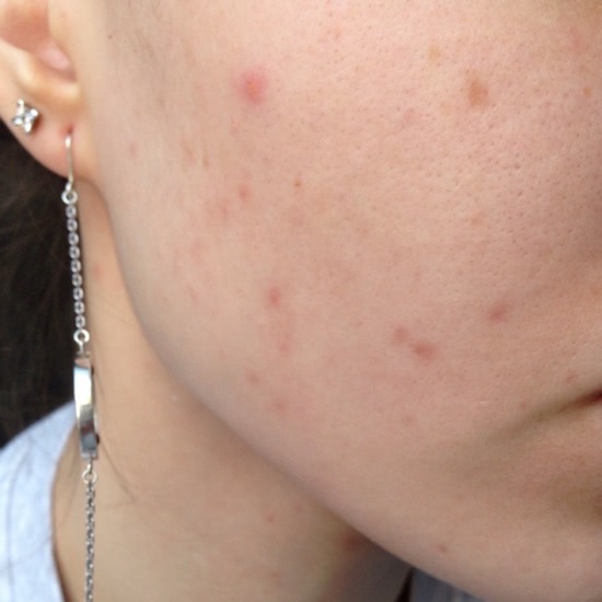 Эффективная борьба с постакне от Kiehl's: Clearly corrective dark spot solution