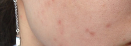 Эффективная борьба с постакне от Kiehl's: Clearly corrective dark spot solution