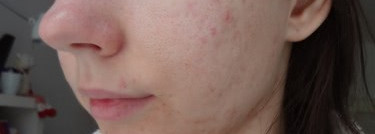 Кислоты в моем уходе