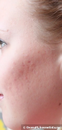 Отзывы и лечение кожи лица