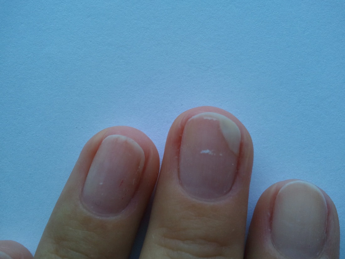 Почему растет кожа под ногтями, и что с этим делать?