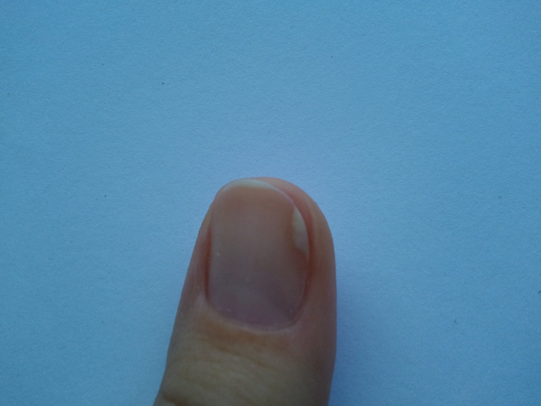 Ушиб ногтя – признаки, виды, методы лечения, осложнения и риски, профилактика