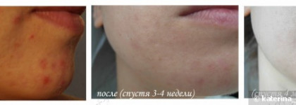 Спасение моей кожи или год без "штукатурки"