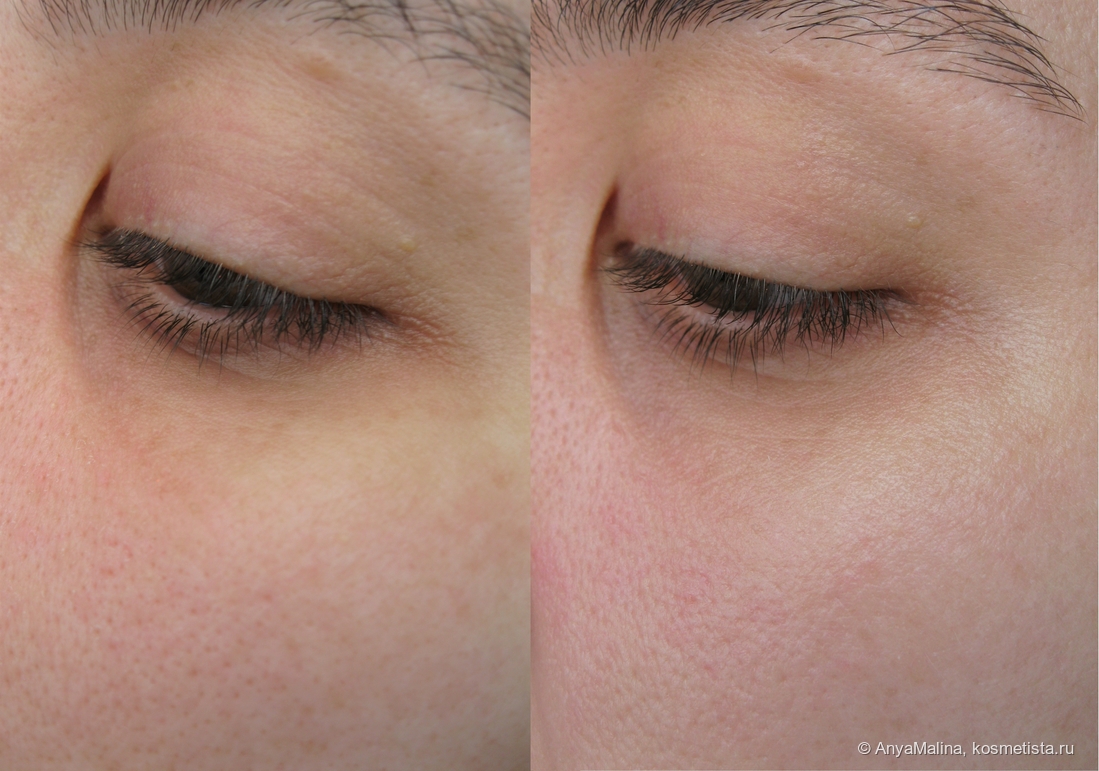 До и после на лице: хорошо заметно естественное сияние после санскрина