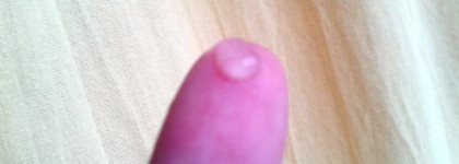 Укрепление зубов с реминерализующим гелем Remineralizing gel R.o.c.s и маленький секрет