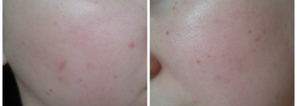 Красивый, ровный тон кожи летом с МАС