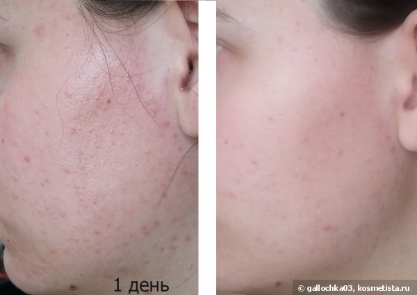 Средства для улучшения кожи лица отзывы