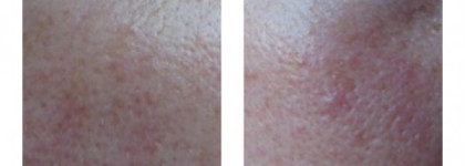 Акне, купероз, розацеа? Sesderma Azelac на страже красивой кожи