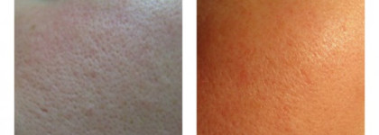 Акне, купероз, розацеа? Sesderma Azelac на страже красивой кожи