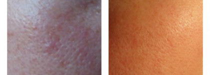 Помощь чувствительной коже с поврежденными капиллярами - Algologie Caress Day Cream