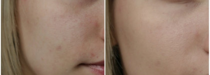 Lumene Bright Now Vitamin C Balancing BB Cream SPF 20 в оттенке 01 Light