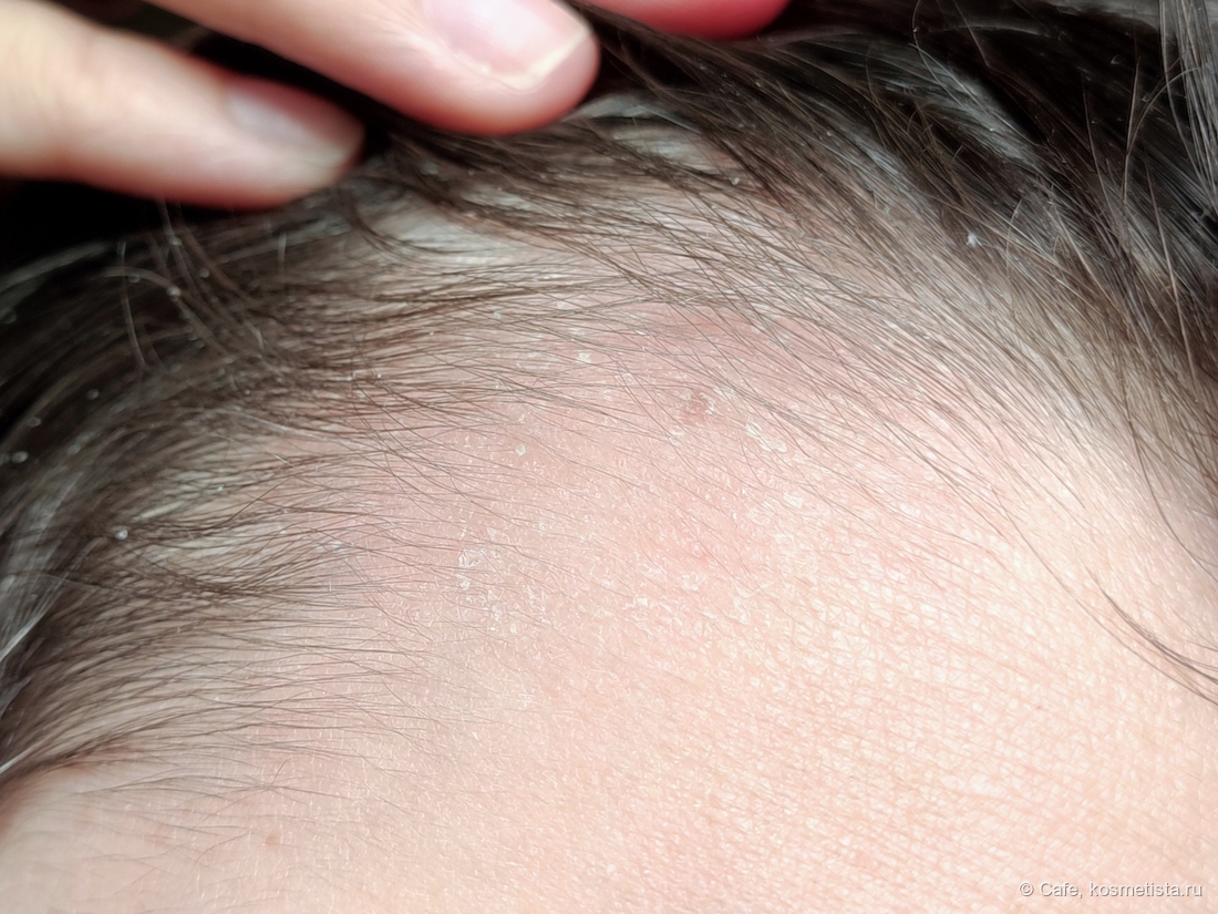 После одного применения