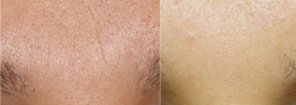 Результат есть! Medik8 Pretox Eyelift anti-ageing four peptide Under-Eye Dark Circle Formula