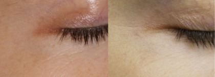 Результат есть! Medik8 Pretox Eyelift anti-ageing four peptide Under-Eye Dark Circle Formula