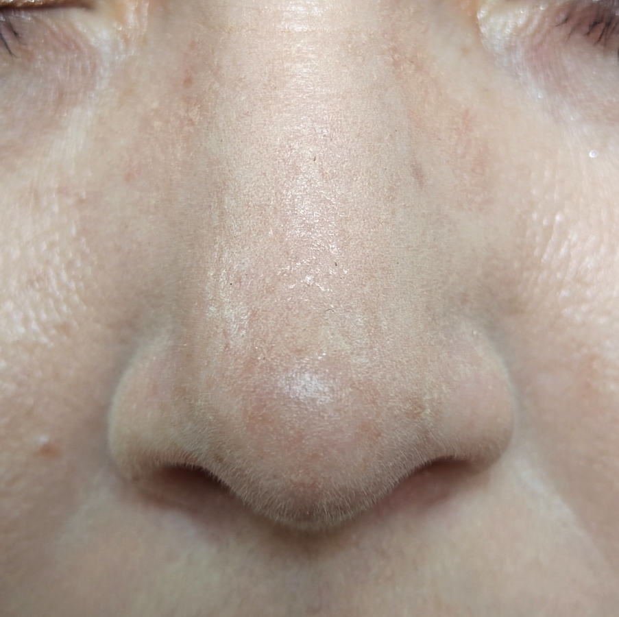 12-30. На фото можно увидеть следы от очков ближе к переносице