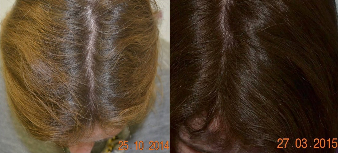 Фото до и после мезотерапии волос
