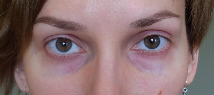 Темные круги под глазами заболевания. Синие круги подтглазами. Фиолетовые синяки под глазами.