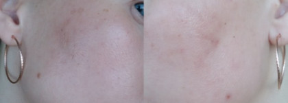 Гликолевый пилинг в домашних условиях с Reviva Labs, 10% Glycolic Acid Cream или эксперимент, длиною в месяц