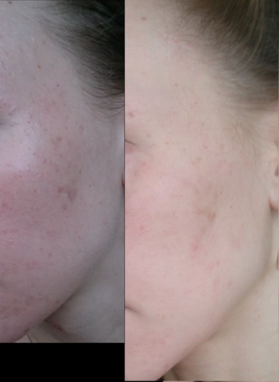 Гликолевый пилинг в домашних условиях с Reviva Labs, 10% Glycolic Acid Cream или эксперимент, длиною в месяц