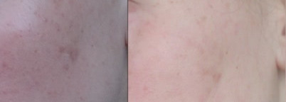 Гликолевый пилинг в домашних условиях с Reviva Labs, 10% Glycolic Acid Cream или эксперимент, длиною в месяц