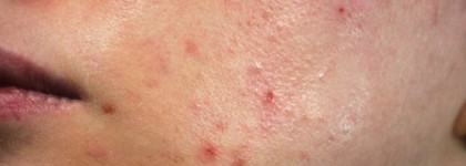 Показываю детокс-эффект на проблемной коже. DMK Danne Montegue King Epitoxyl