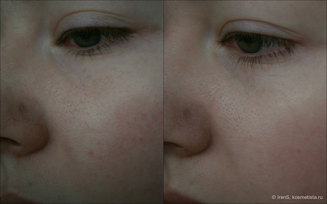 Крем для кожи лица с проявлениями купероза capillary clear отзывы