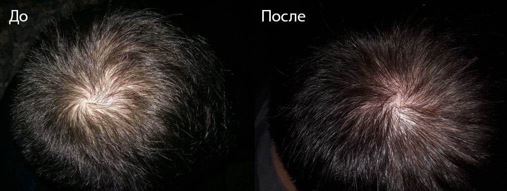 Система 4 шампунь терапевтический 4 для жирной кожи головы отзывы