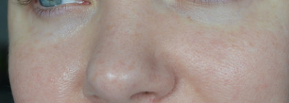 Подбор ухода для очень жирной кожи на холодное время года