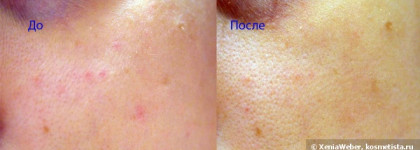 Paula’s Choice Resist Weekly Retexturizing Foaming Treatment  4% BHA