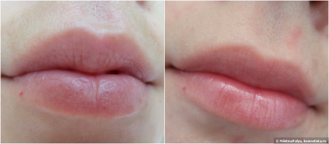 Удаление малых губ до и после фото. Фото после наращивания губ ,последствия.