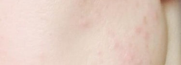 IS Clinical- Active Serum или акне возраст не помеха