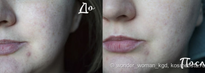 Новинка от Garnier Тканевая маска для лица Garnier "Увлажнение + Комфорт"! И как всегда,в посте наглядный результат