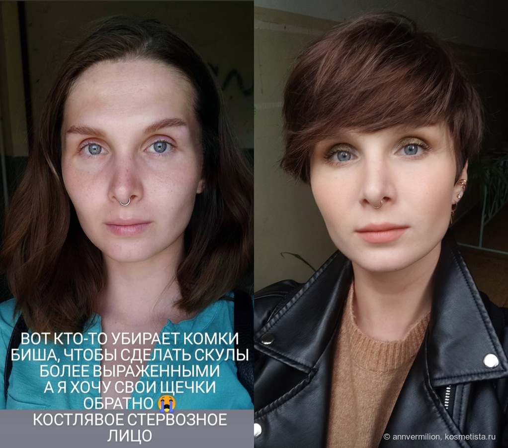 Филлеры для лица до и после фото